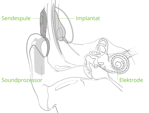 Cochlea Implantat Einfach Dazugehoeren